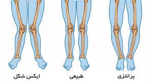 زانوی پرانتزی (Genu Varum): از تشخیص تا درمان + تمرینات اصلاحی مؤثر