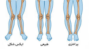 زانوی پرانتزی (Genu Varum): از تشخیص تا درمان + تمرینات اصلاحی مؤثر